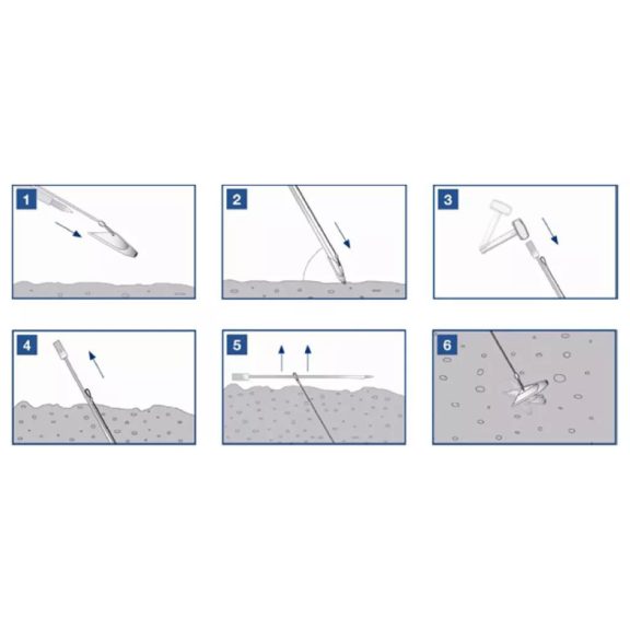 GRIPPLE® végoszlop feszítő horgony Anchor3